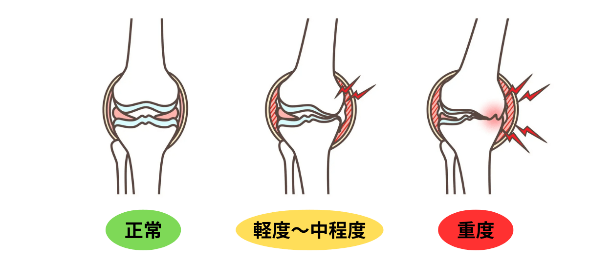 変形性膝関節症の図解